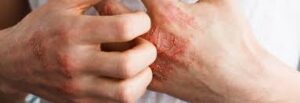 PSORIASIS